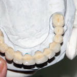 implantologia dentale prezzi intera arcata dentale