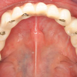 implantologia dentale prezzi intera arcata dentale