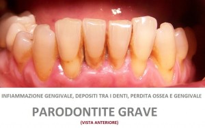 parodontite-GRAVE