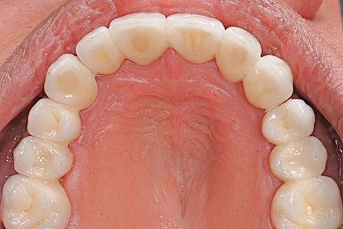 Protesi dentali fisse circolari senza gengiva su impianti dentali